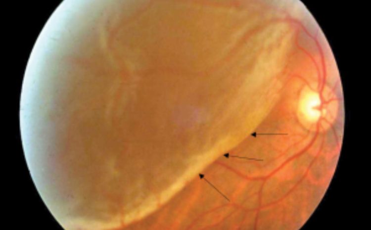  Retinal Detachment