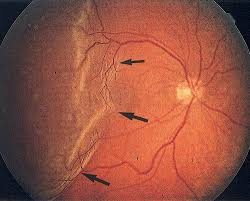 Retinal Detachment Treatment