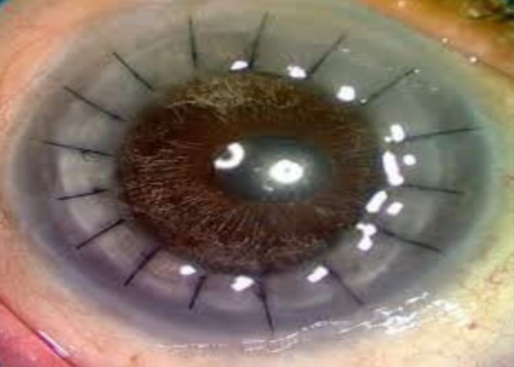 AEH conducted 2nd round of Corneal Transplant