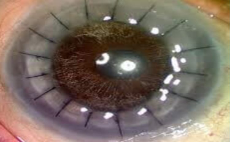  AEH conducted 2nd round of Corneal Transplant